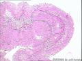 请教！膀胱新生物。图1