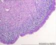 输卵管子宫内膜异位症？输卵管粘膜子宫内膜化生？请老师们指导！图11