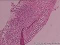 HPV阳性，TCT报ASC-US，宫颈活检6点CIN1,宫颈环切图9