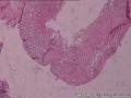 HPV阳性，TCT报ASC-US，宫颈活检6点CIN1,宫颈环切图6