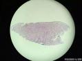 孔祥田老师病例讨论F28  cervical biopsy已点评图1