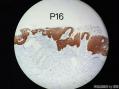 孔祥田老师病例讨论F25 PAP and cervical biopsy已点评图5