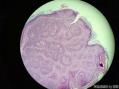 孔祥田老师病例讨论59 M right medial cheek 已点评图3