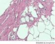 浸润性脂肪瘤图17