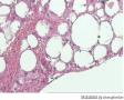 浸润性脂肪瘤图16