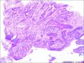 52岁，全切子宫，宫颈腺上皮是成熟鳞化吗？请老师们回复图2