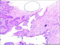 52岁，全切子宫，宫颈腺上皮是成熟鳞化吗？请老师们回复图3