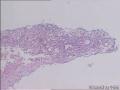 膀胱新生物图3