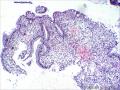 功血（临床标本太少，求助各位老师，这个报告怎么发？）图1