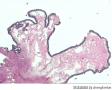 卵巢交界性囊腺瘤？图16