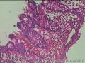乙状结肠粘膜图40