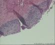 请老师看看64岁TCT，CIN II ，HPV感染？图5