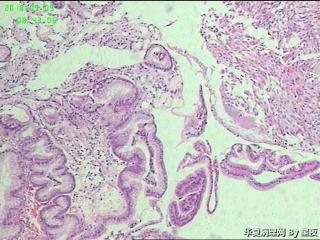 胃体活检组织，腺癌？请教？图2