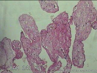 右卵巢妊娠组织物图47