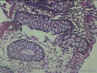 直乙结肠粘膜图13