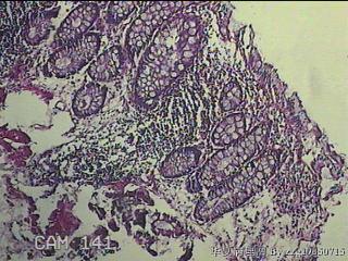 直乙结肠粘膜图3