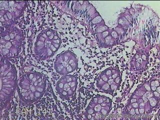 直乙结肠粘膜图20