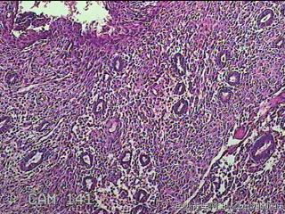 宫腔内膜组织图11