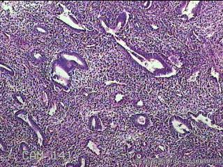 宫腔内膜组织图18