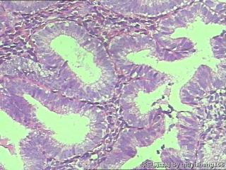 宫内膜活检--复杂性增生图10