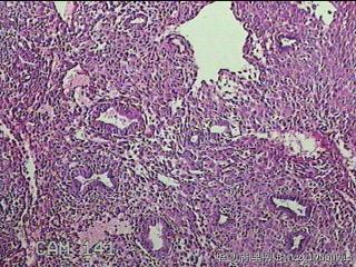 宫腔内膜组织图49