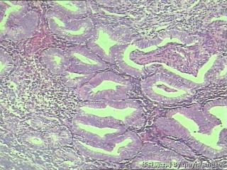 宫内膜活检--复杂性增生图12