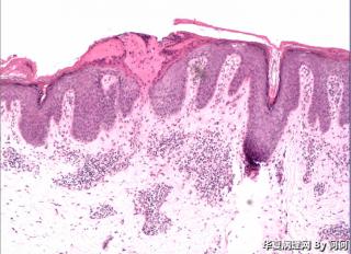 皮肤的，请教。描述还是炎症。图1