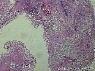 食管中段粘膜图5