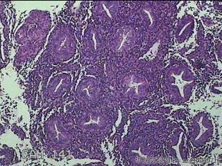 宫腔内组织图48