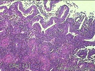 宫腔内组织图17