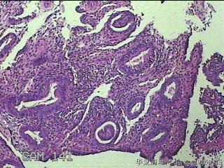 宫腔内组织图22