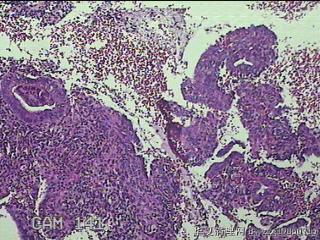 宫腔内组织图34