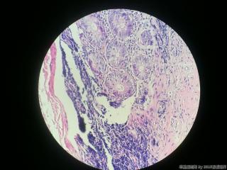 有结构异型，无细胞异型，考虑阑尾腺体异位吗？图8