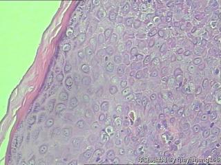 小阴唇赘生物--乳头瘤？恶性？图11