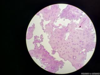 阴道流血原因待查，尿HCG 阴性，看着有点像退变的绒毛吗图12