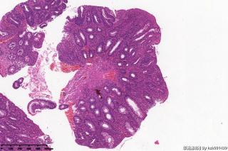 乙状结肠组织，临床怀疑溃疡性结肠炎。图11