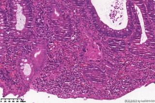 乙状结肠组织，临床怀疑溃疡性结肠炎。图31