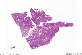 乙状结肠息肉图14