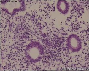 宫颈锥切物，请帮忙看看！谢谢！图38-41是ECC图49