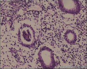 宫颈锥切物，请帮忙看看！谢谢！图38-41是ECC图47
