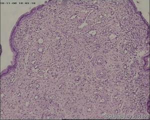 宫颈锥切物，请帮忙看看！谢谢！图38-41是ECC图44
