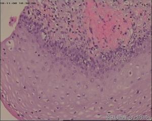 宫颈锥切物，请帮忙看看！谢谢！图38-41是ECC图34