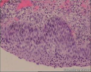 宫颈锥切物，请帮忙看看！谢谢！图38-41是ECC图10