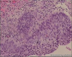 宫颈锥切物，请帮忙看看！谢谢！图38-41是ECC图11