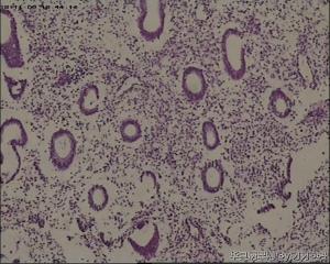 宫颈锥切物，请帮忙看看！谢谢！图38-41是ECC图46
