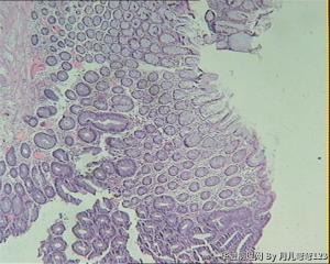 乙状结肠息肉图2