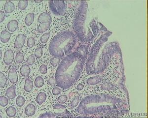 乙状结肠息肉图10
