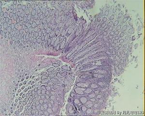 乙状结肠息肉图1