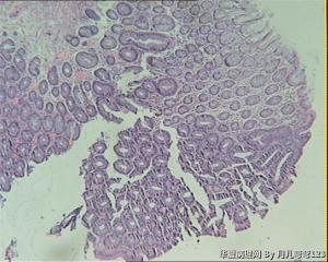 乙状结肠息肉图4