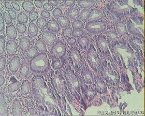 乙状结肠息肉图14